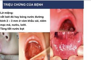 BỆNH TAY CHÂN MIỆNG NẶNG Ở TRẺ EM ĐÃ XUẤT HIỆN TRỞ LẠI